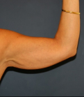 Feel Beautiful - Arm Reduction 201 - Before Photo